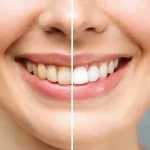 tooth-bleaching-aadeindia-dental-courses-for dentists