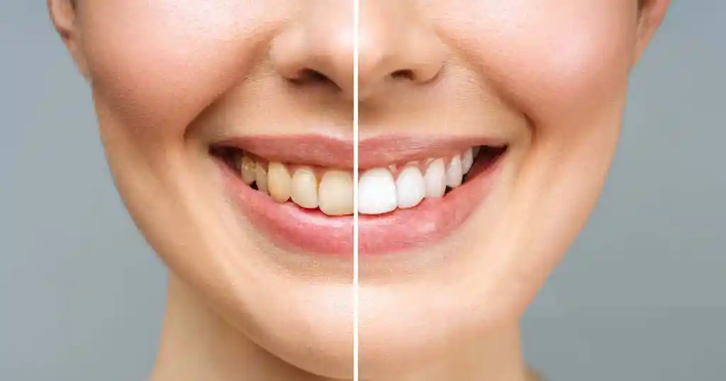 tooth-bleaching-aadeindia-dental-courses-for dentists