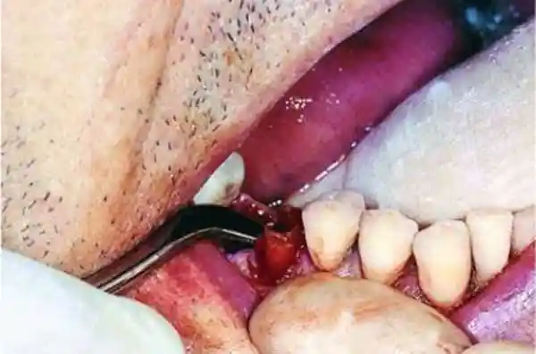 Advantages of Oral Surgery Course at AADEINDIA