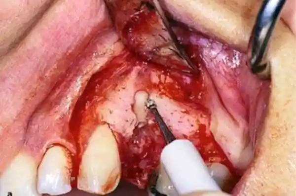 Clinical practice during Oral Surgery Course at AADEINDIA